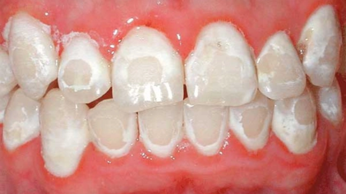 Lớp phủ nano dễ bị mẻ, vỡ, bong tróc sau thời gian ngắn sử dụng (Nguồn: St)